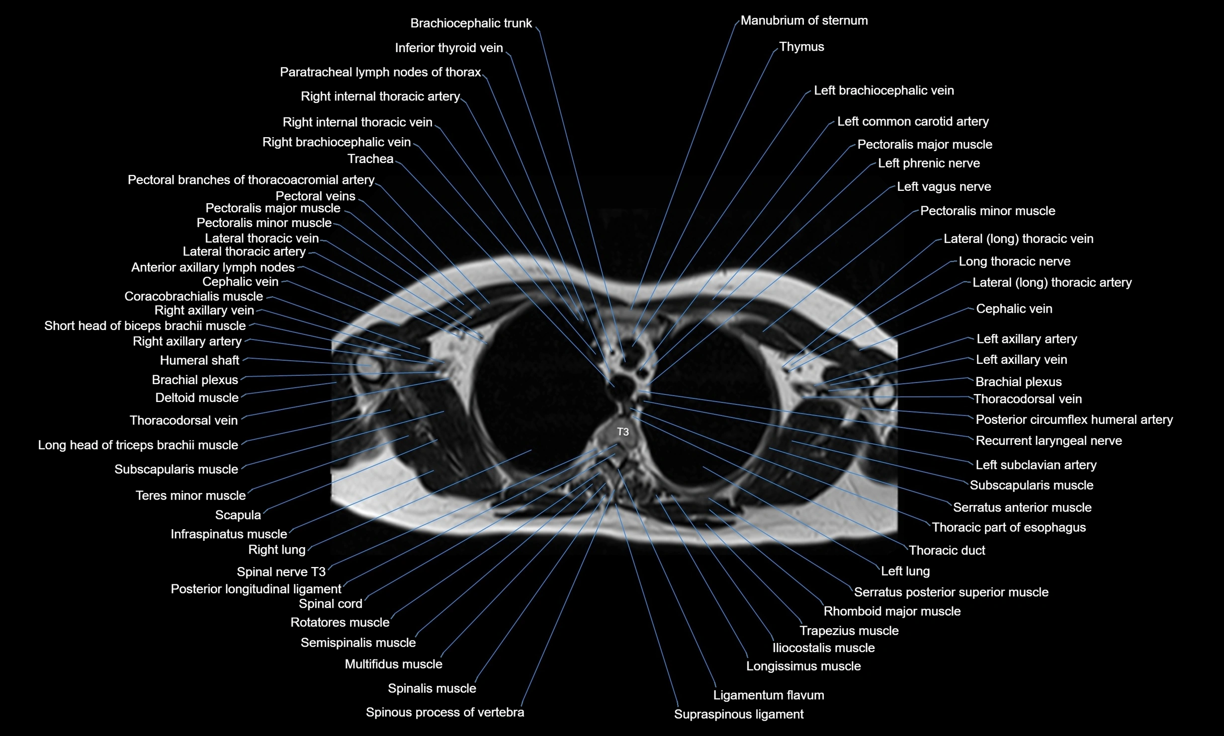 MRI chest axial  cross sectional anatomy 3T radiology  image-img-00001-00012.webp